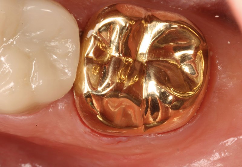 Gold tooth to replace a damaged tooth